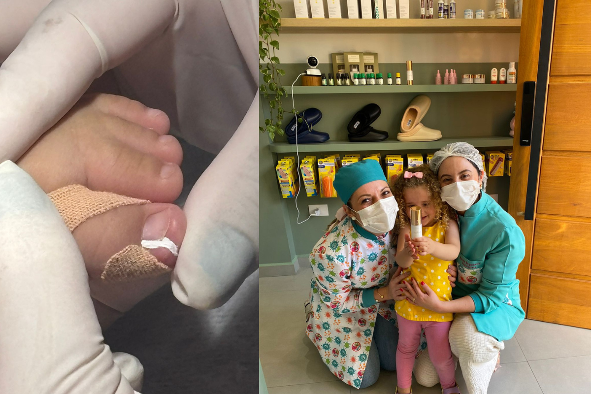 Podopediatria Unha encravada em crianças